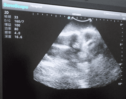 Knee Arthrocentesis Ultrasound Training Model 